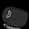 SPORK, NICO - 22.03.1976 - 02.08.2022 - CT obere Extremität - 17:59:38